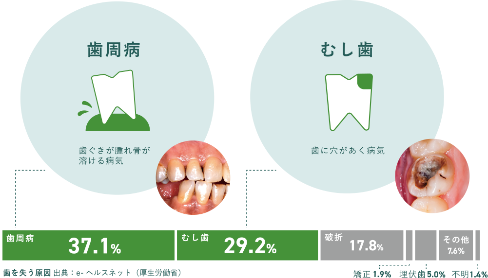 歯周病 37.1%　虫歯 29.2%　破折 17.8%　矯正1.9%　埋伏歯 5.0%　その他 7.6%　不明 1.4%